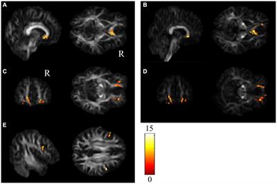 Longitudinal assessment of chemotherapy-induced brain connectivity changes in cerebral white matter and its correlation with cognitive functioning using the GQI